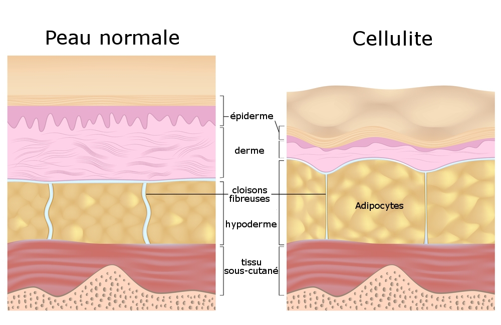 Qu'est-ce que la cellulite ? – Labodahlia